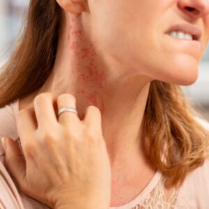 img of someone with a rash